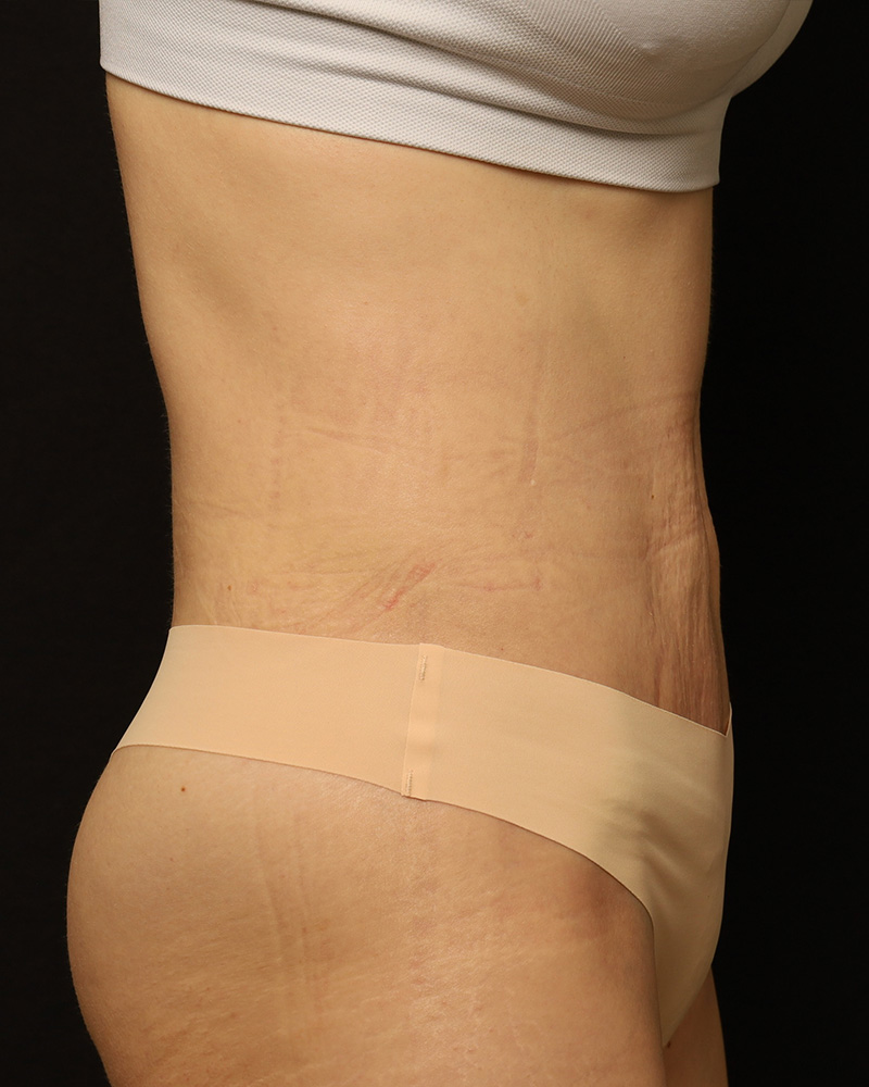 Tummy Tuck Before and After 42