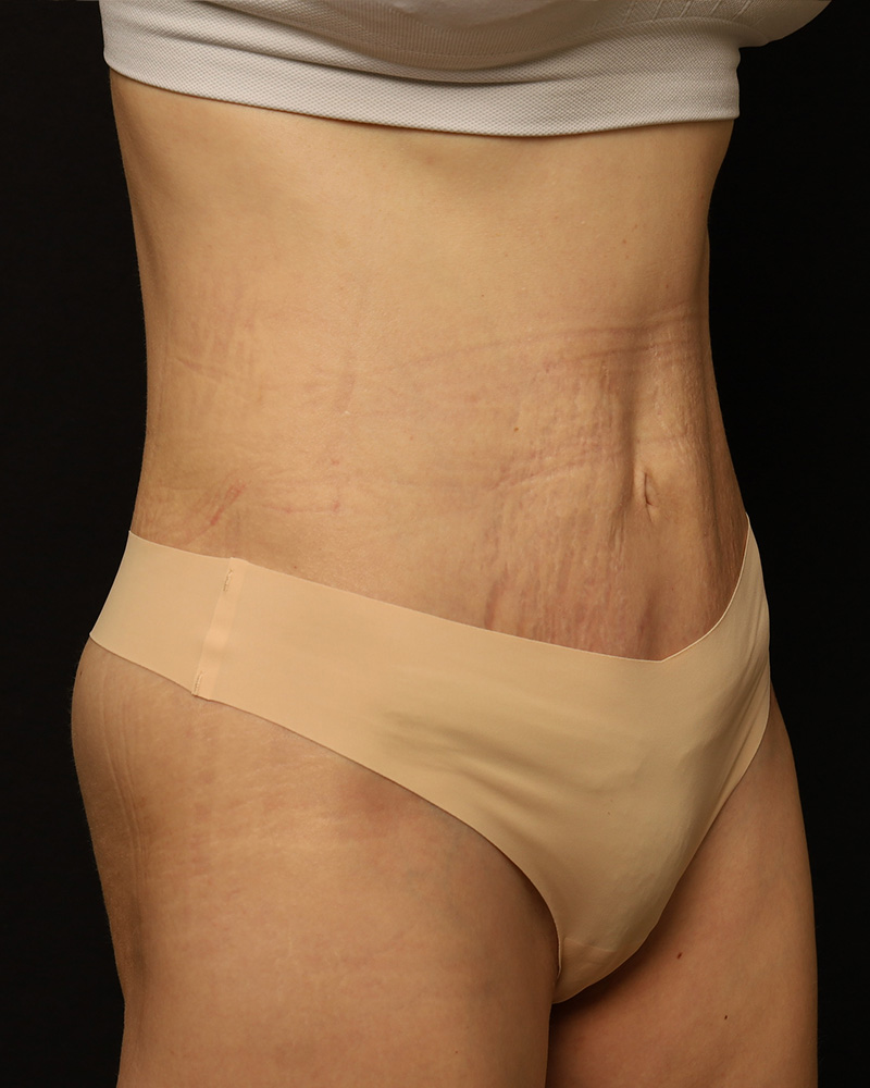 Tummy Tuck Before and After 44