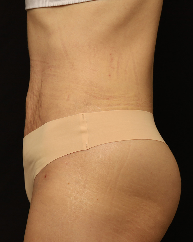Tummy Tuck Before and After 44