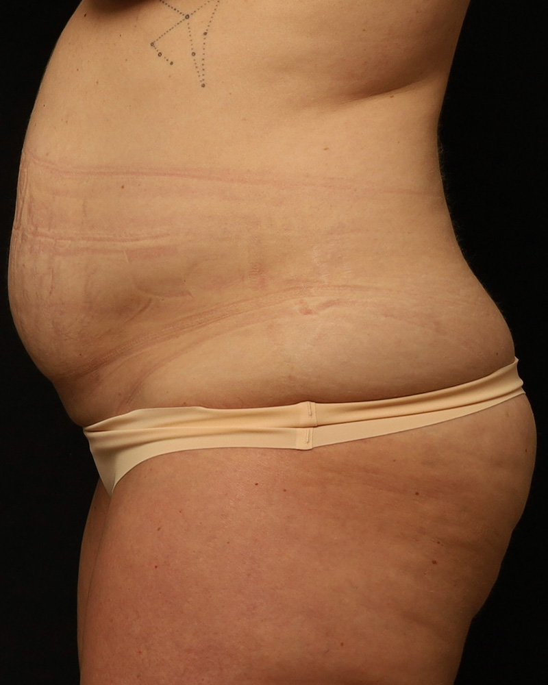 Tummy Tuck Before and After 44
