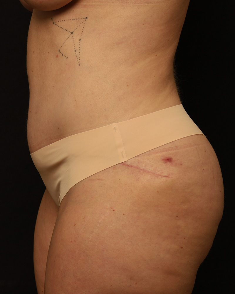 Tummy Tuck Before and After 44