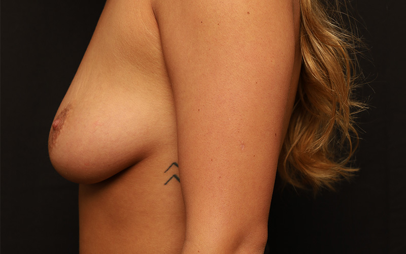 Breast Augmentation And Lift Before and After 13