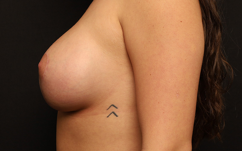 Breast Augmentation And Lift Before and After 13
