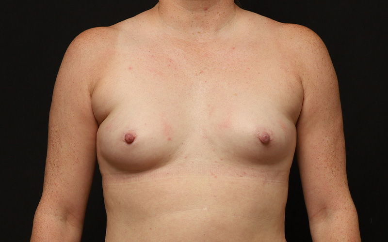 Breast Augmentation Before and After 01