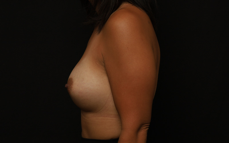 Breast Augmentation Before and After 05