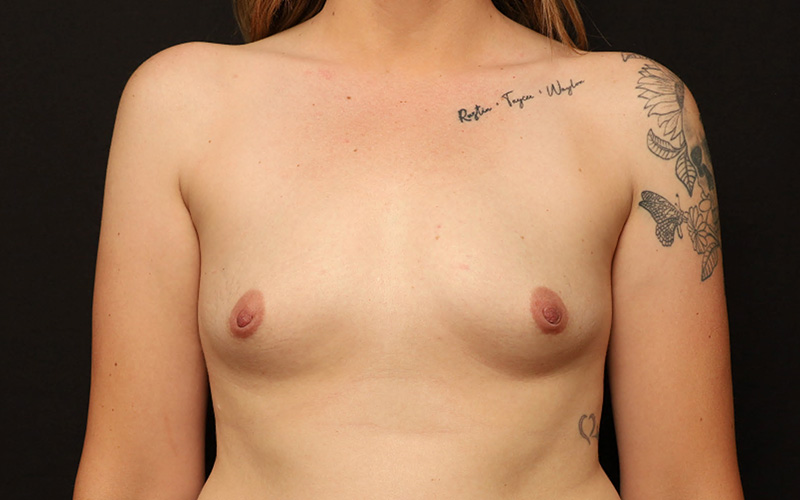 Breast Augmentation Before and After 104