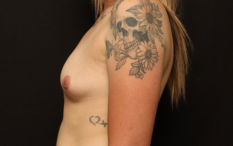 Breast Augmentation Before and After 104