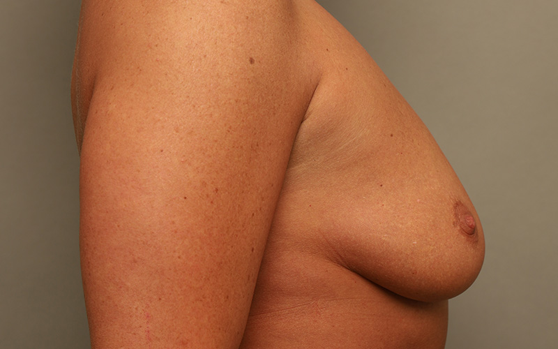 Breast Augmentation Before and After 110