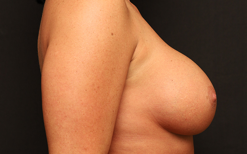 Breast Augmentation Before and After 110