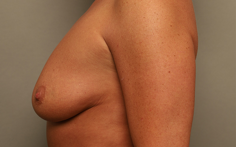 Breast Augmentation Before and After 110