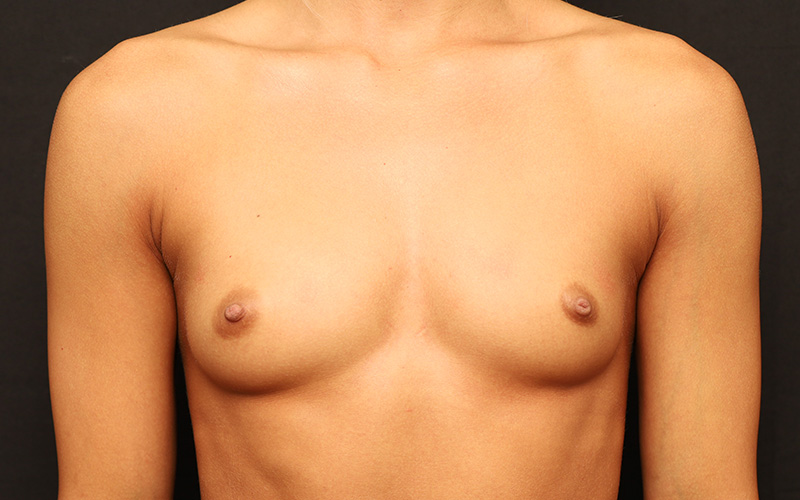 Breast Augmentation Before and After 118