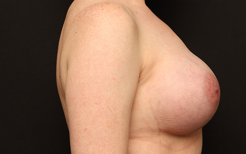 Breast Augmentation Before and After 119