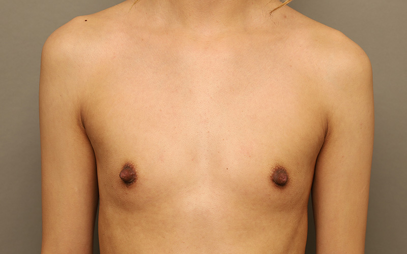 Breast Augmentation Before and After 122