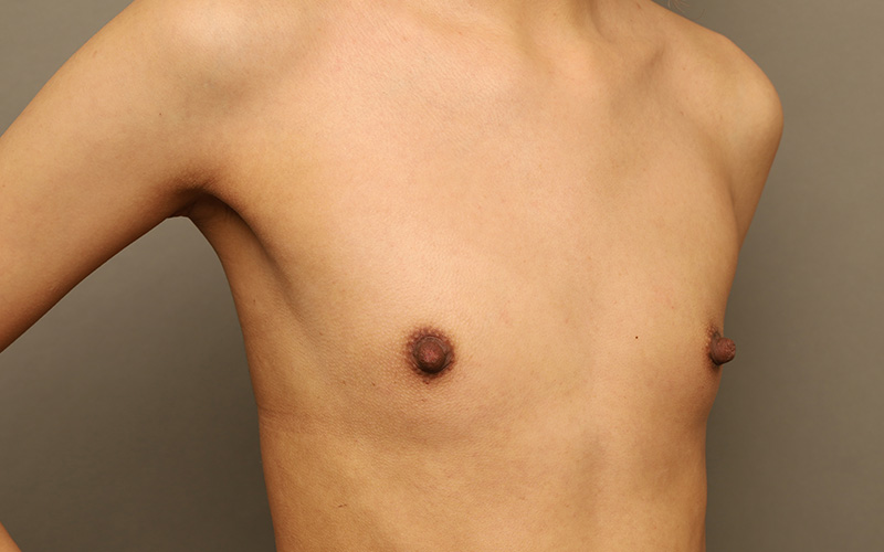 Breast Augmentation Before and After 122