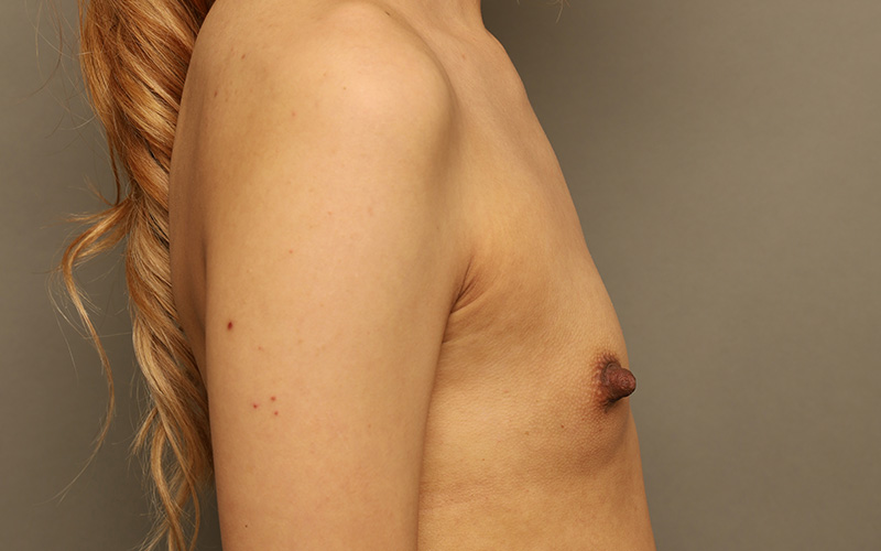 Breast Augmentation Before and After 122