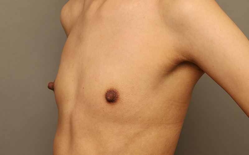 Breast Augmentation Before and After 122