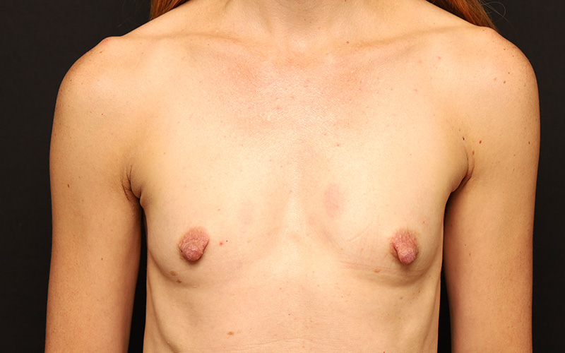 Breast Augmentation Before and After 124