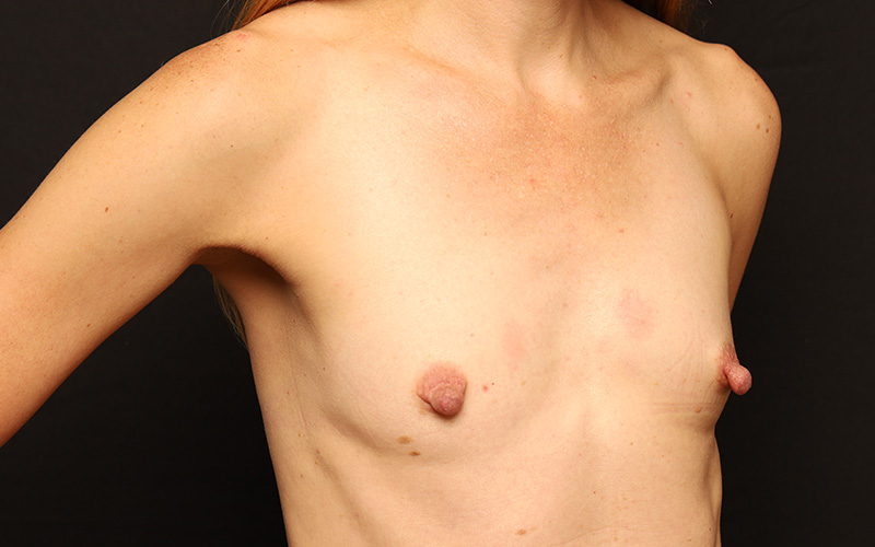 Breast Augmentation Before and After 124