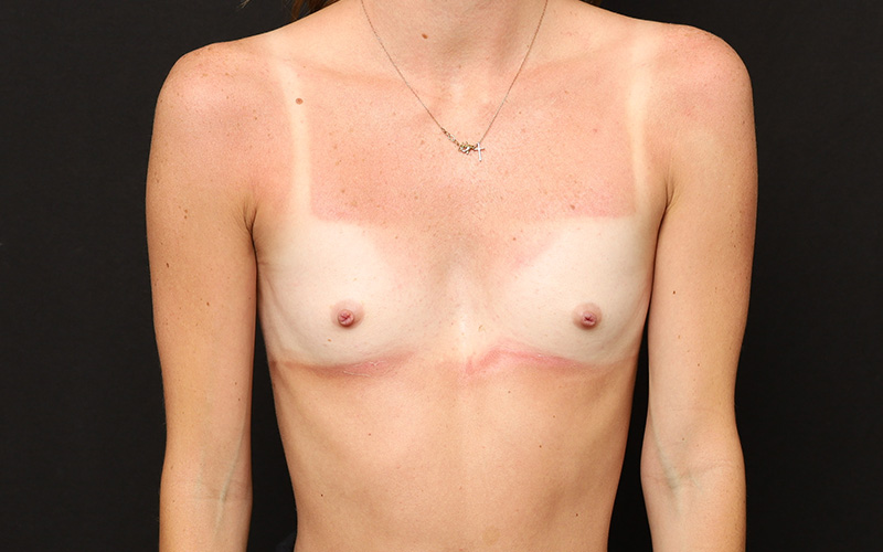 Breast Augmentation Before and After 26