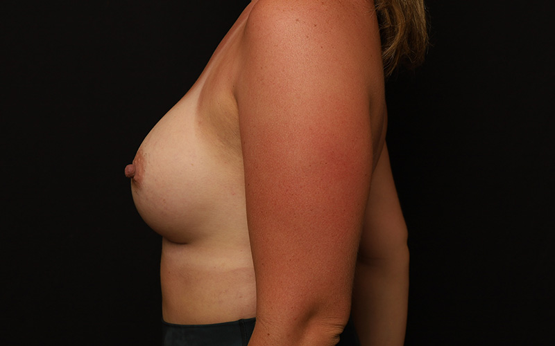 Breast Augmentation Before and After 47