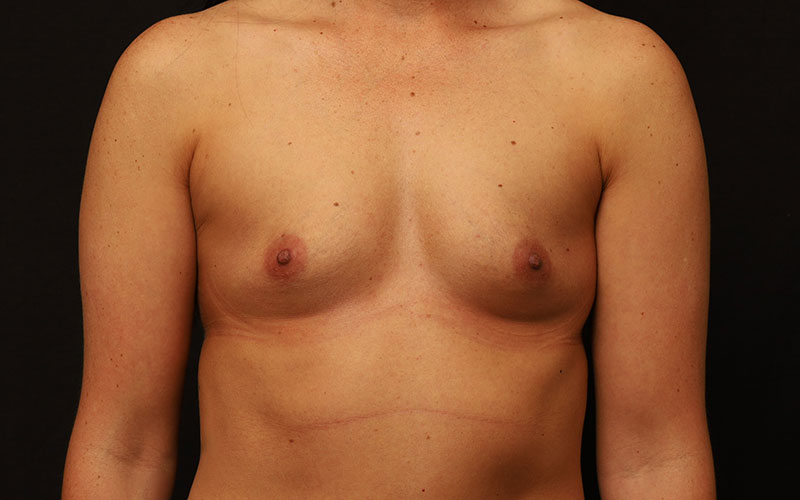 Breast Augmentation Before and After 78