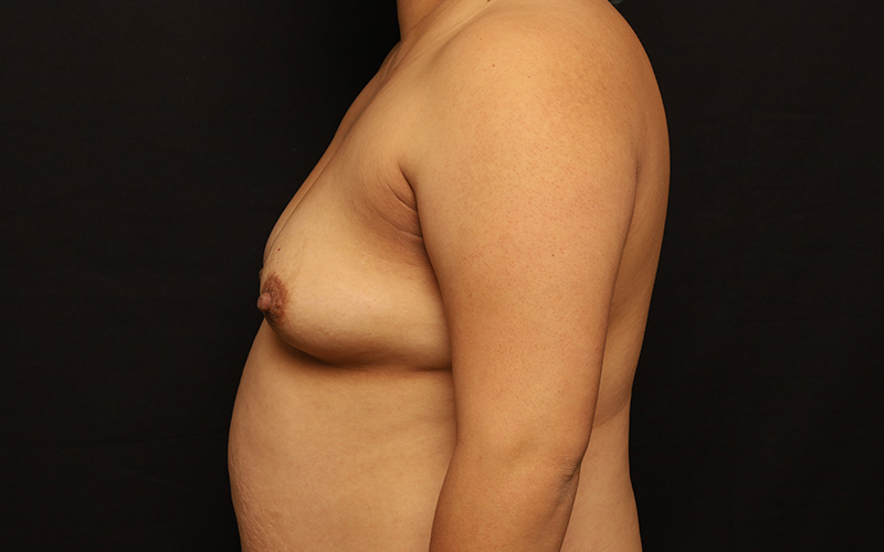 Breast Augmentation Before and After 84