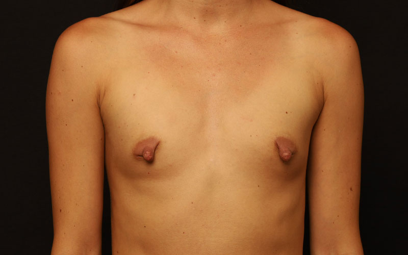 Breast Augmentation Before and After 85