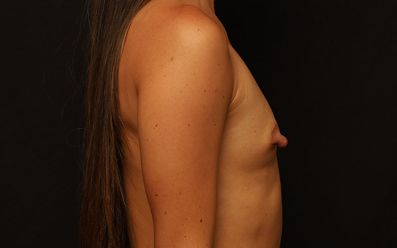 Breast Augmentation Before and After 85