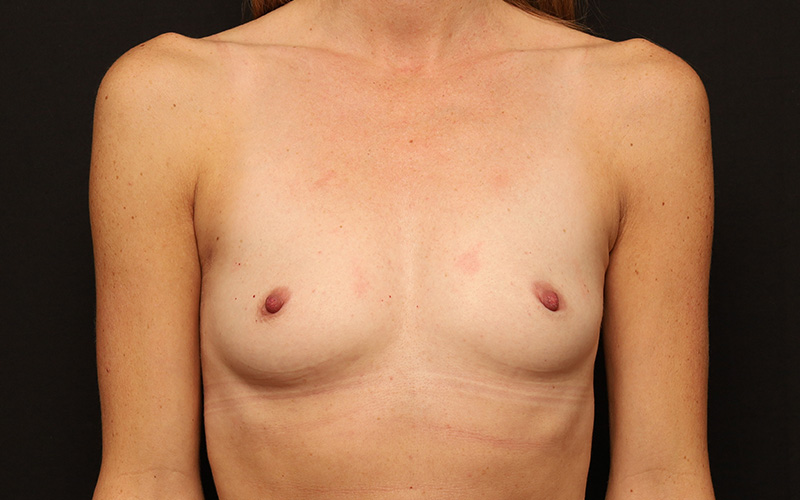 Breast Augmentation Before and After 89