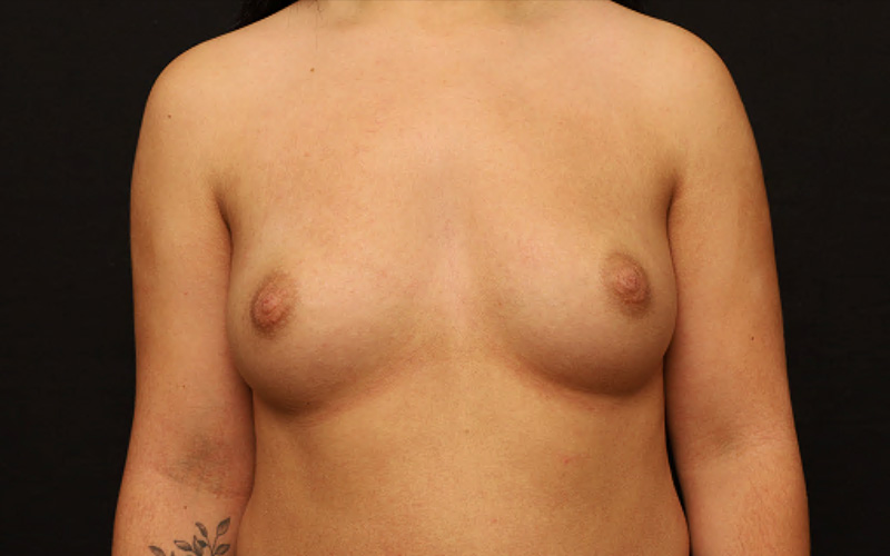 Breast Augmentation Before and After 95