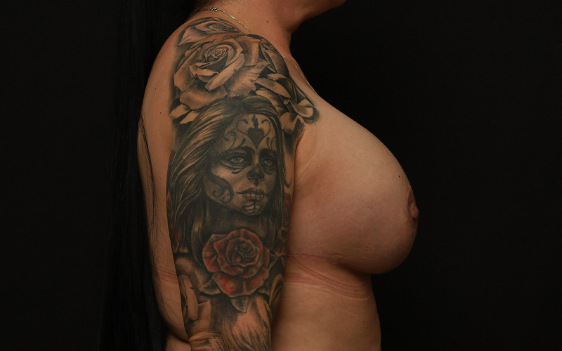 Breast Re-Augmentation Before and After 01