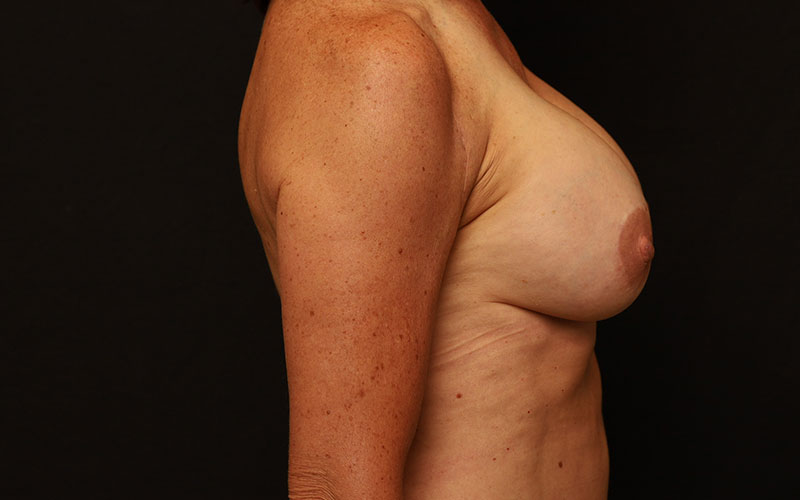 Breast Re-Augmentation Before and After 24
