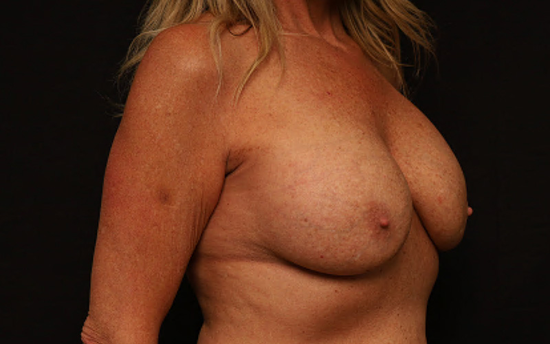 Breast Re-Augmentation Before and After 29