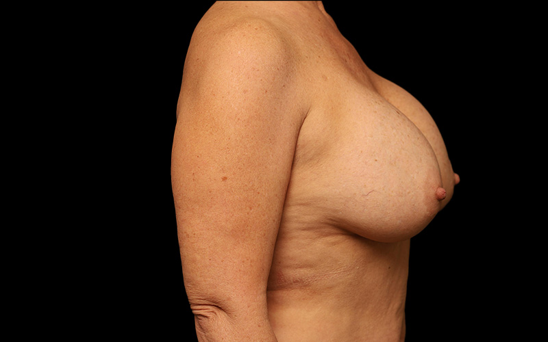 Breast Re-Augmentation Before and After 33