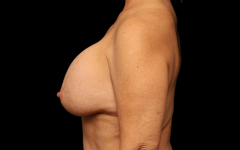 Breast Re-Augmentation Before and After 33