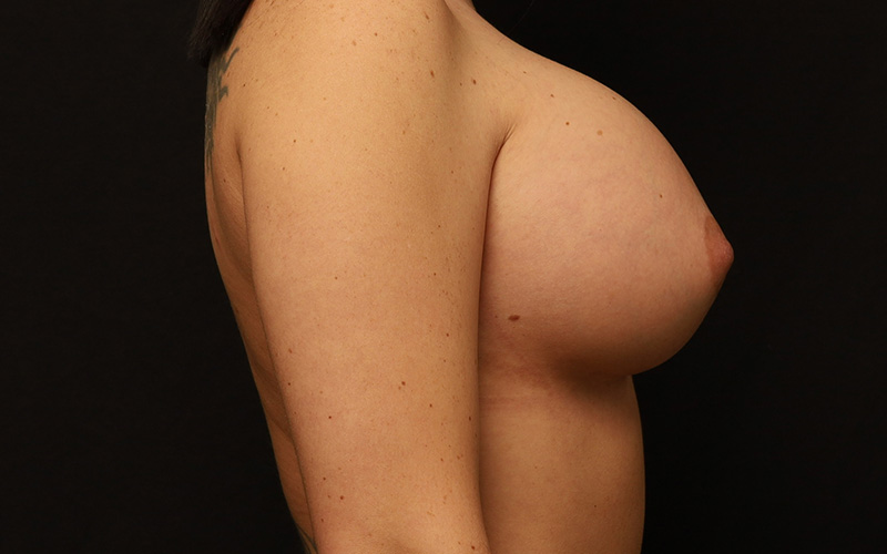 Breast Re-Augmentation Before and After 36
