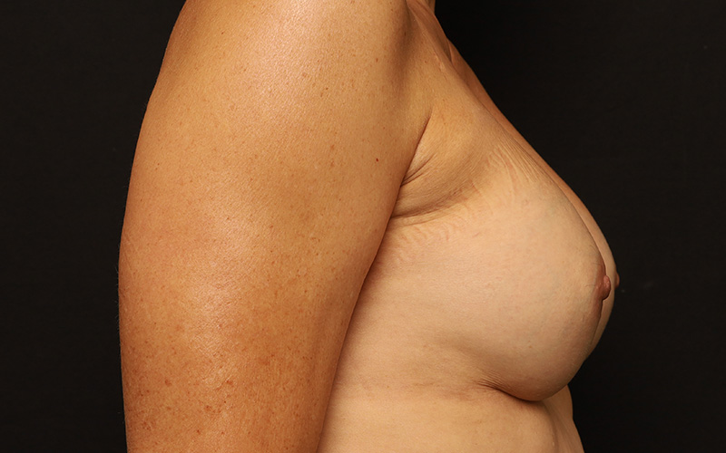 Breast Re-Augmentation Before and After 40