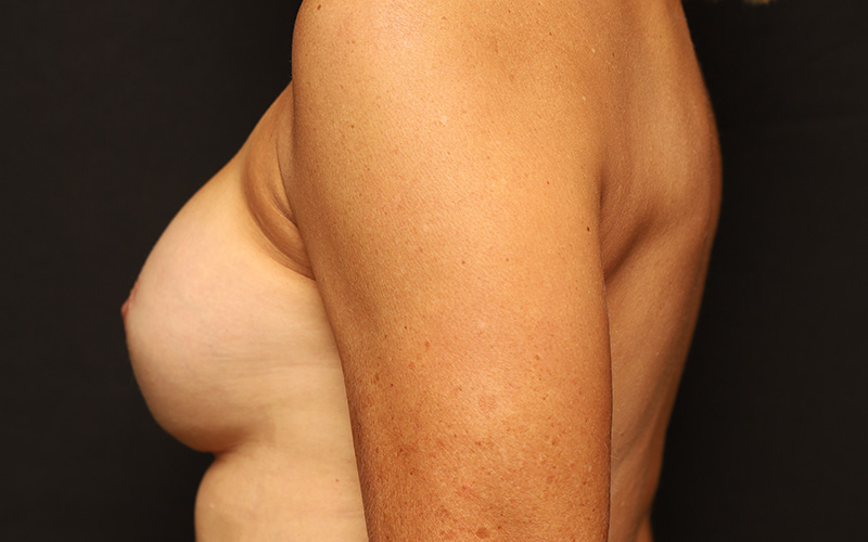 Breast Re-Augmentation Before and After 40