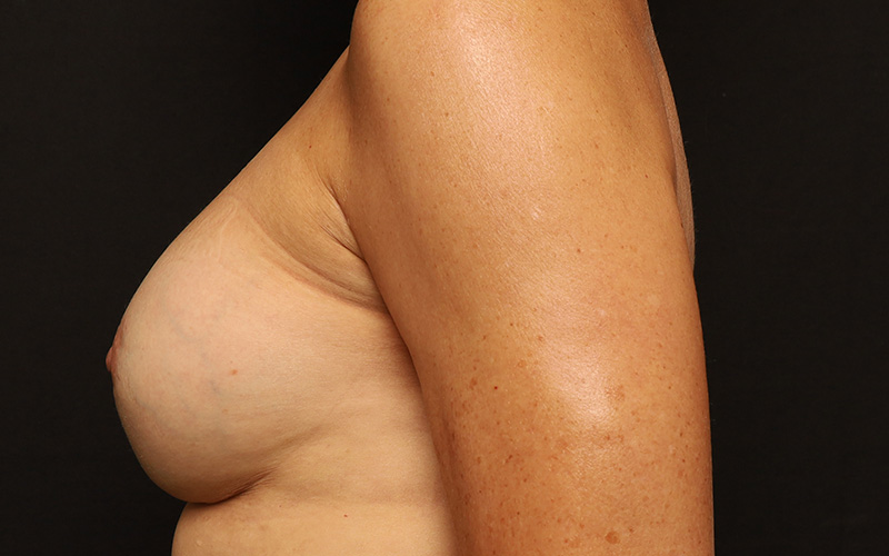 Breast Re-Augmentation Before and After 40