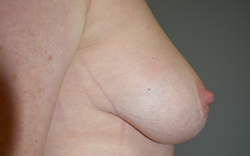 Breast Reduction Before and After 09