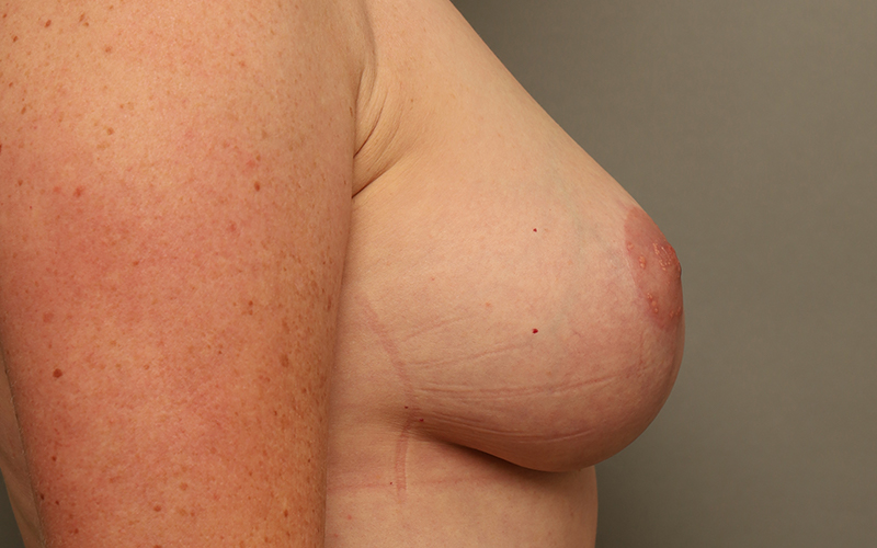 Breast Reduction Before and After 09