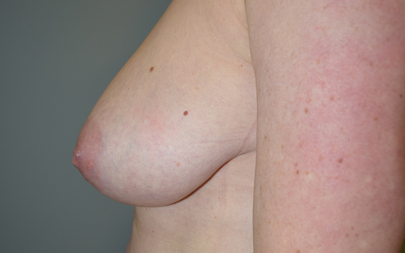 Breast Reduction Before and After 09