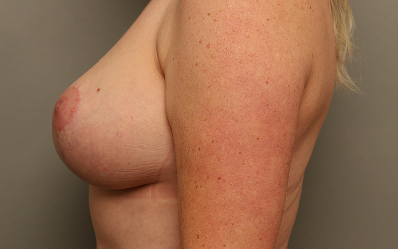 Breast Reduction Before and After 09