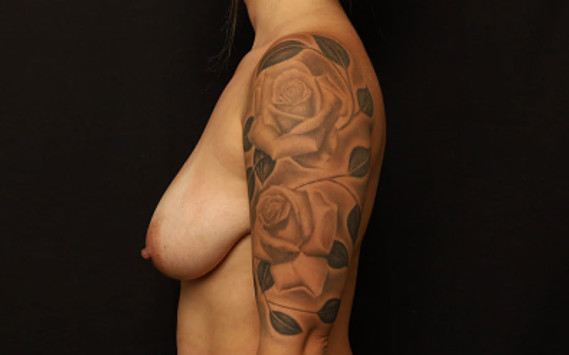 Breast Reshaping With Fat Grafting Before and After 02