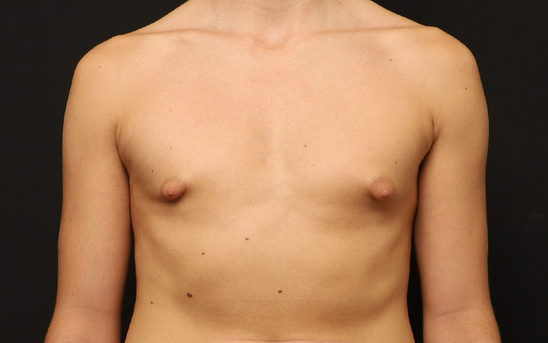 Gynecomastia Before and After 01