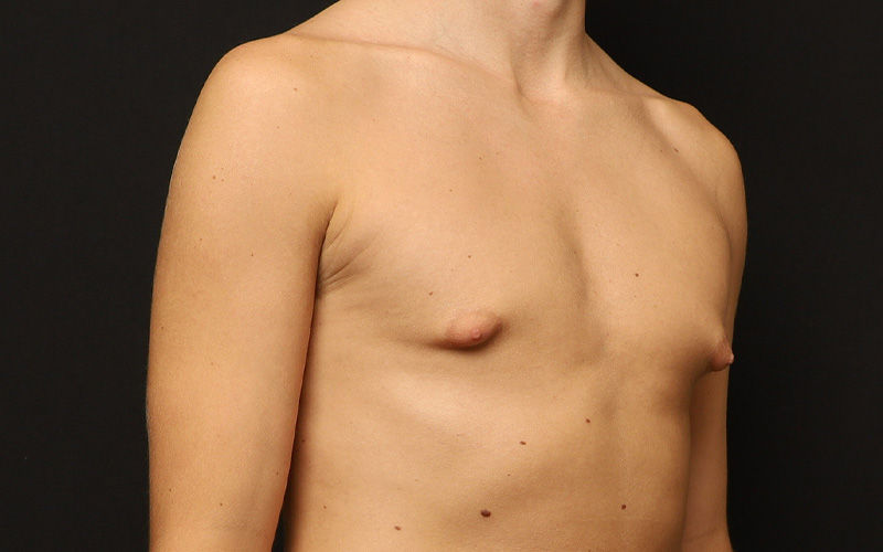 Gynecomastia Before and After 01