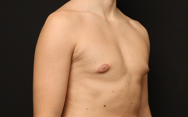 Gynecomastia Before and After 01