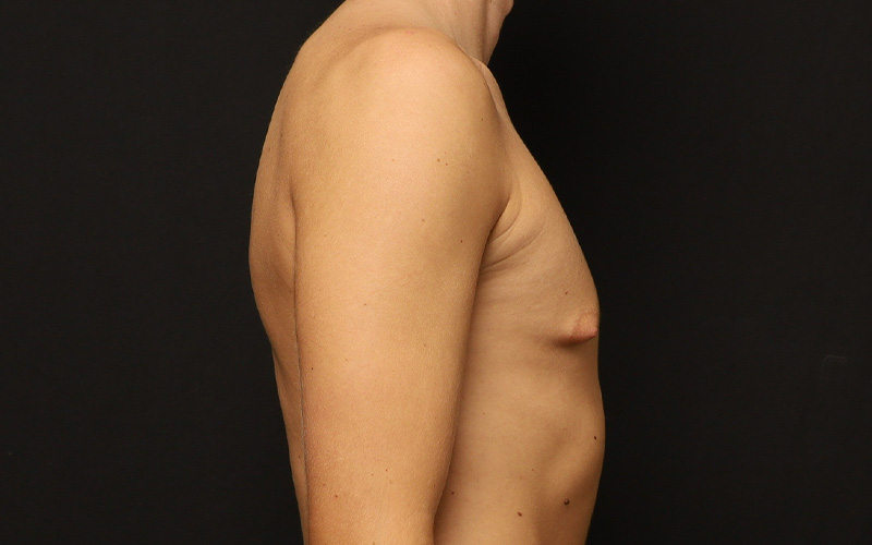 Gynecomastia Before and After 01