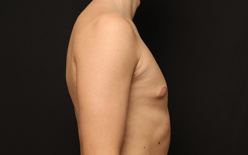 Gynecomastia Before and After 01