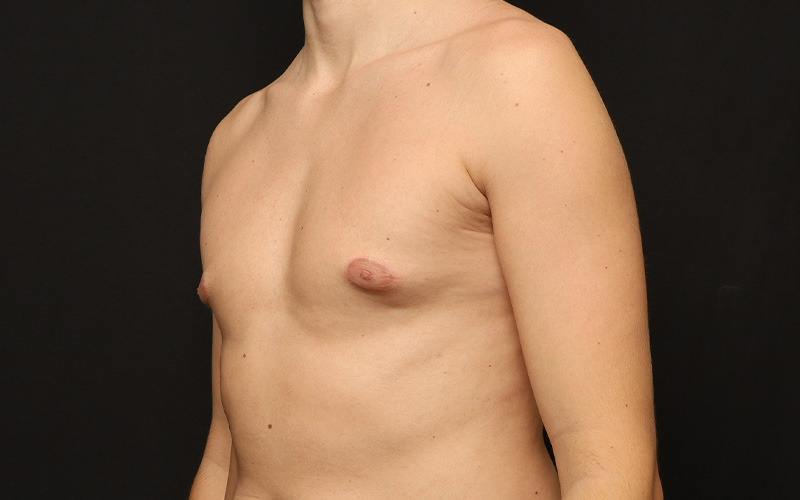 Gynecomastia Before and After 01